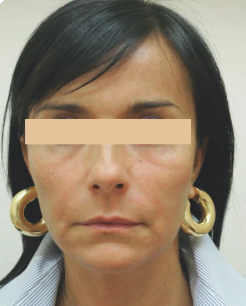 Bochechas e sulcos antes do tratamento