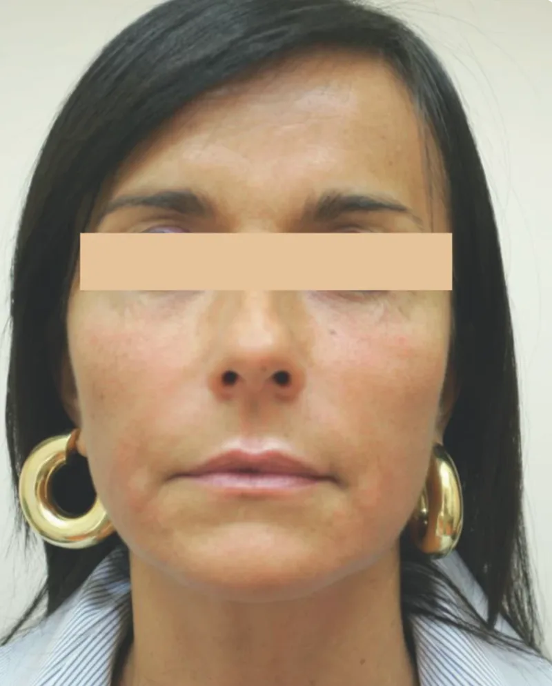 Bochechas e sulcos depois do tratamento